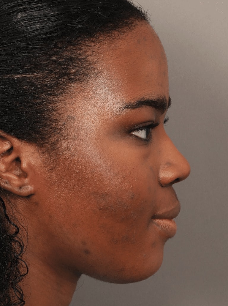 Blepharoplasty Before & After