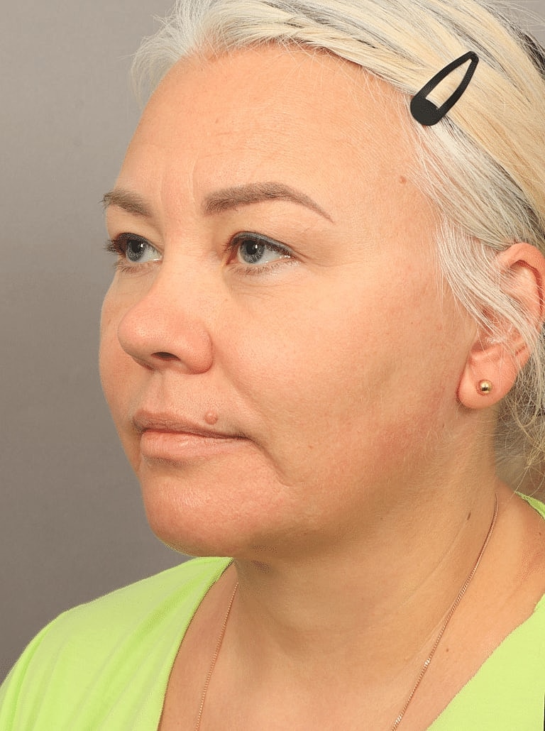 Blepharoplasty Before & After