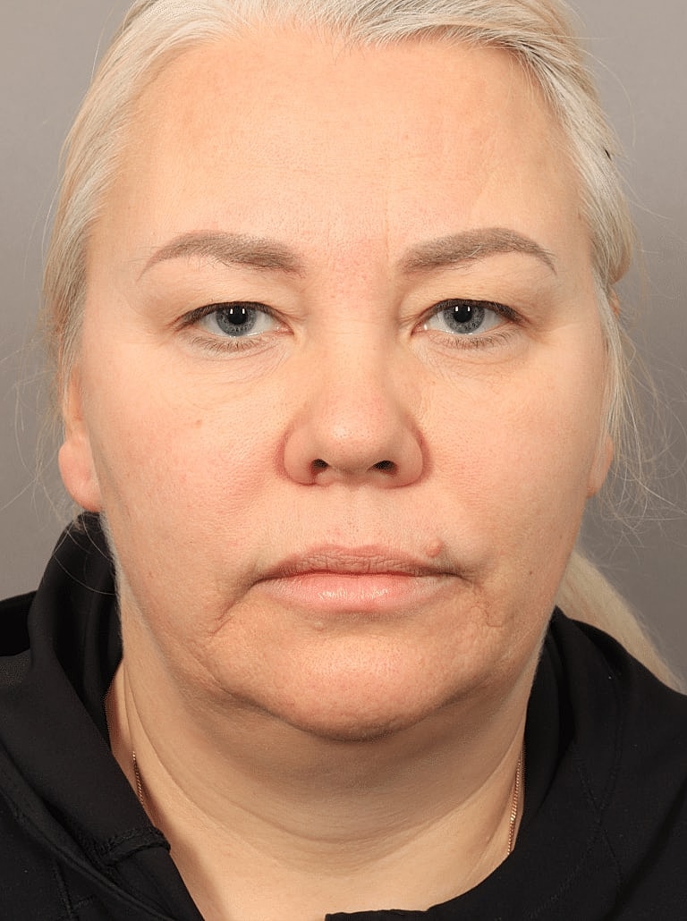 Blepharoplasty Before & After