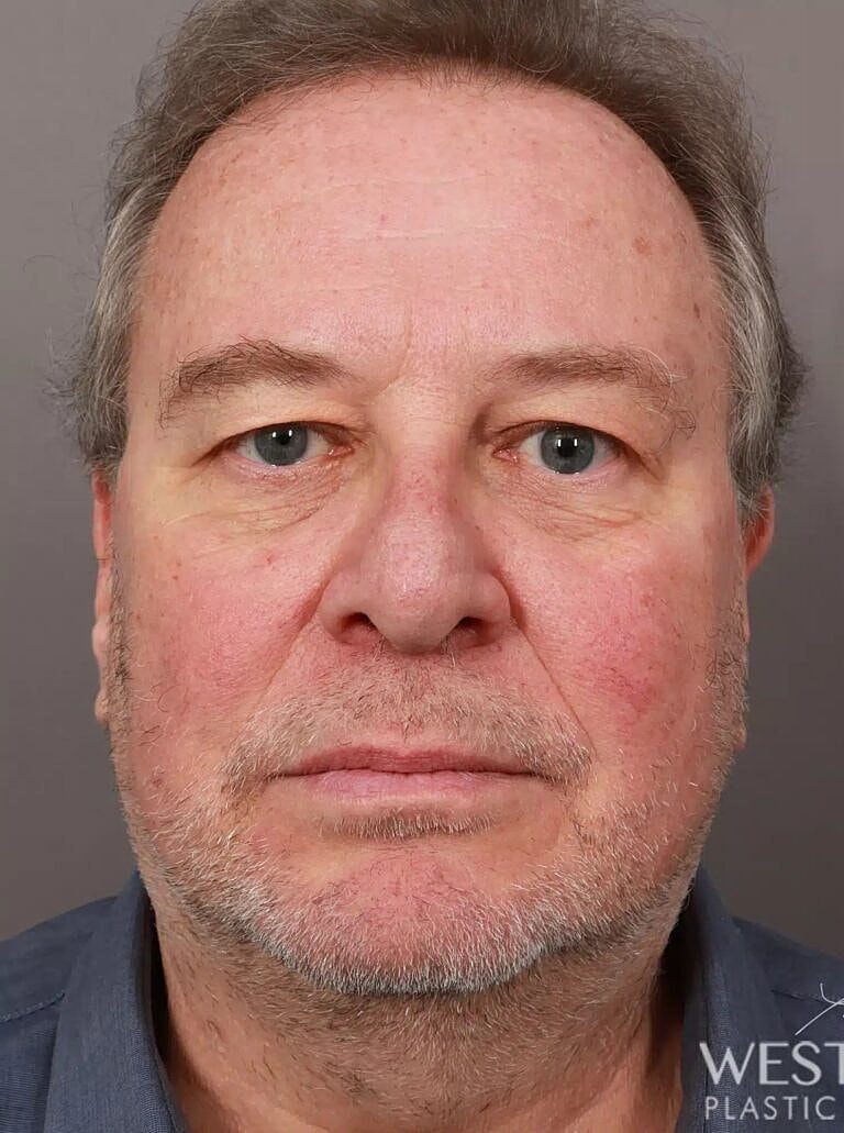 Blepharoplasty Before & After