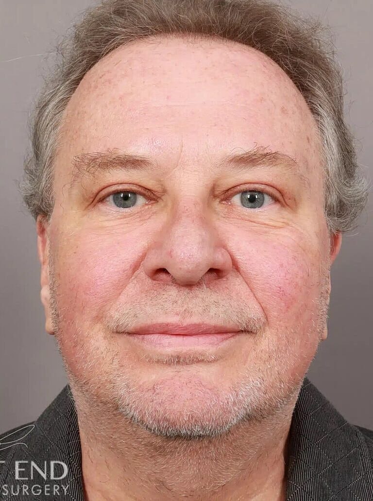 Blepharoplasty Before & After