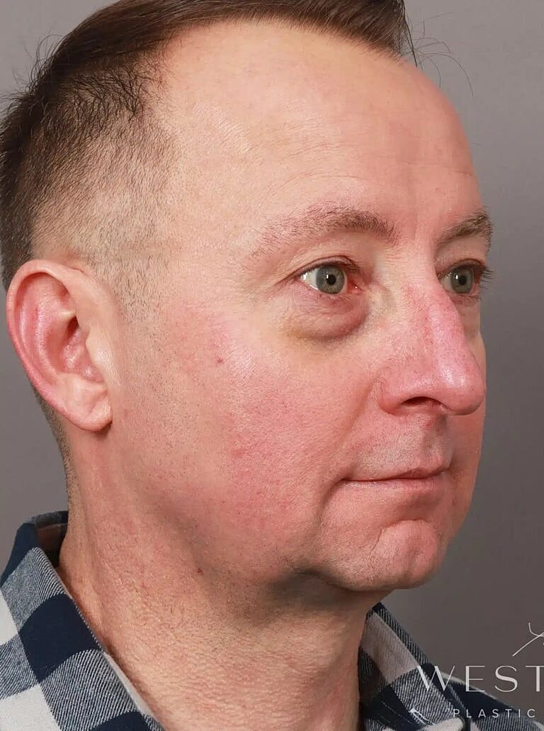 Blepharoplasty Before & After