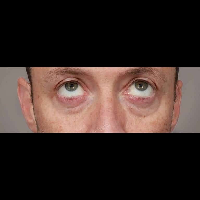 Blepharoplasty Before & After