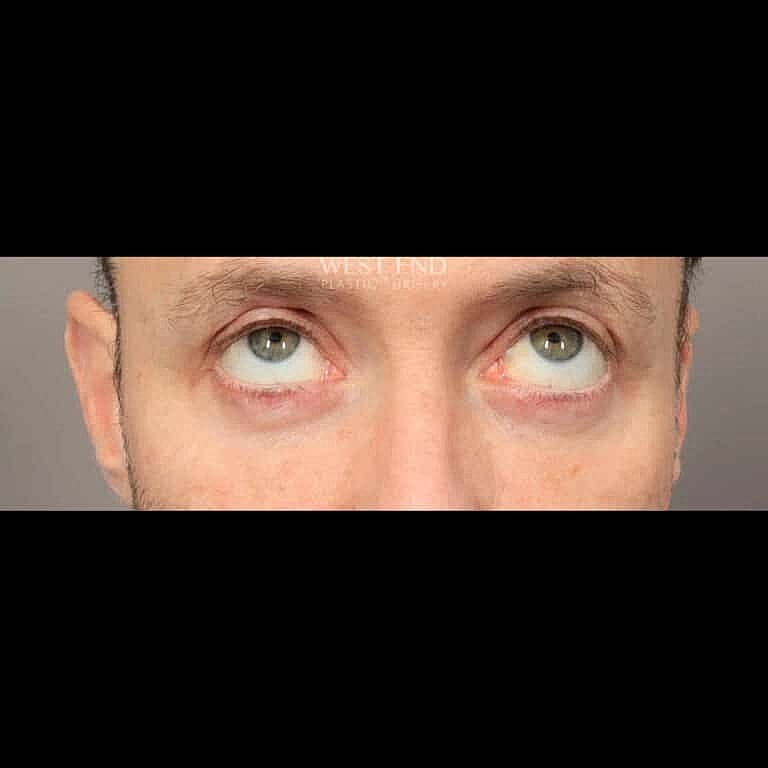Blepharoplasty Before & After