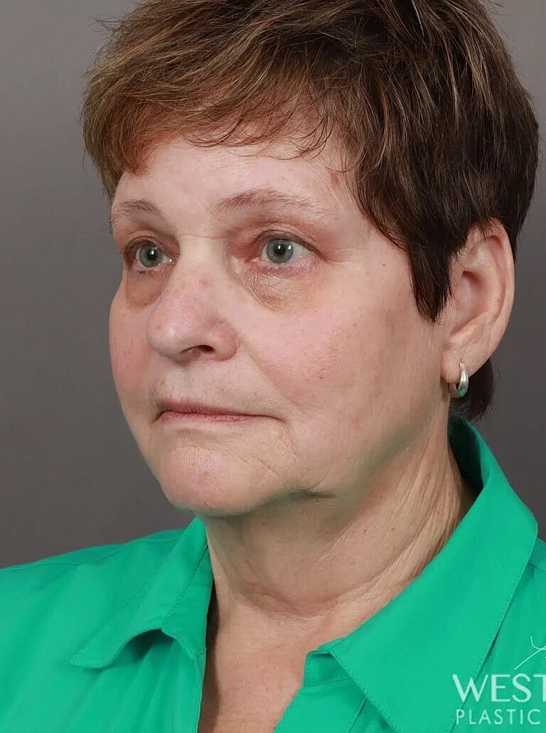 Blepharoplasty Before & After