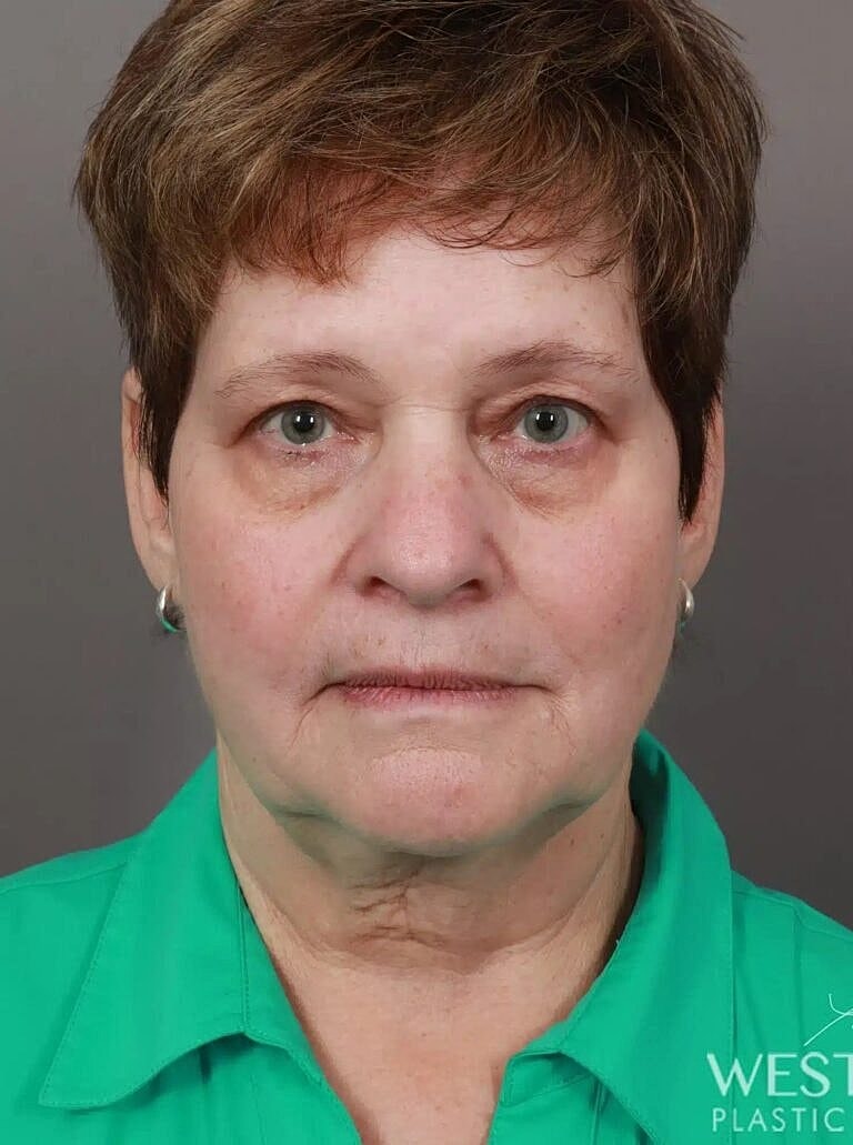 Blepharoplasty Before & After