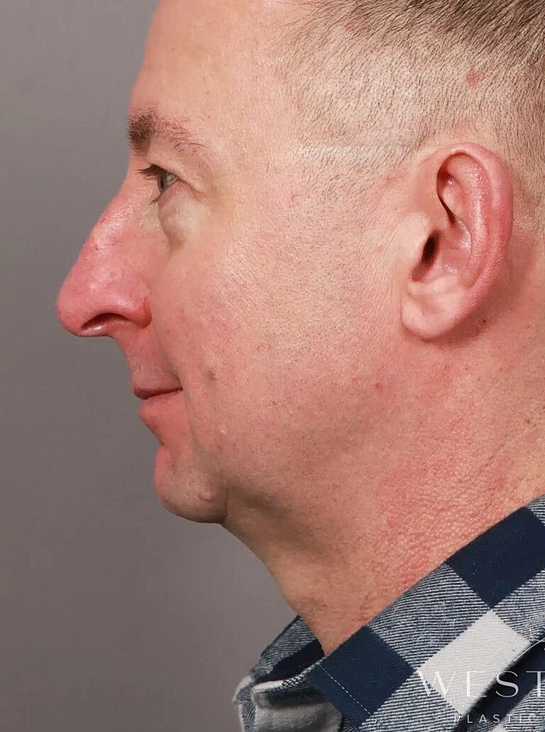 Blepharoplasty Before & After