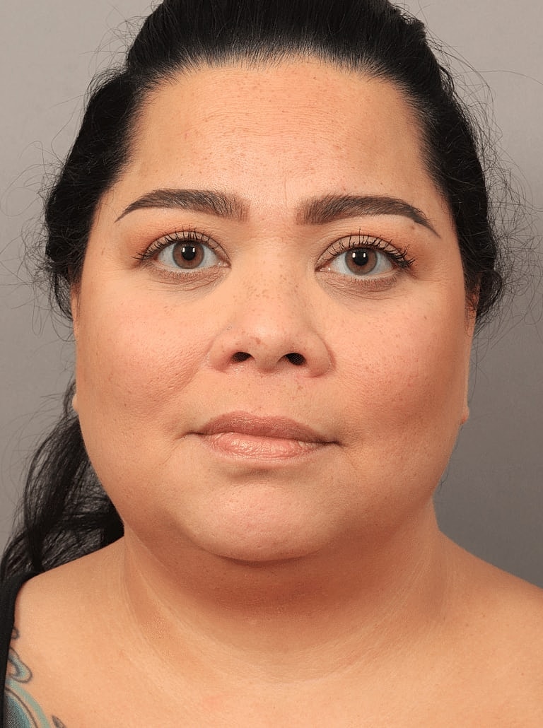 Blepharoplasty Before & After