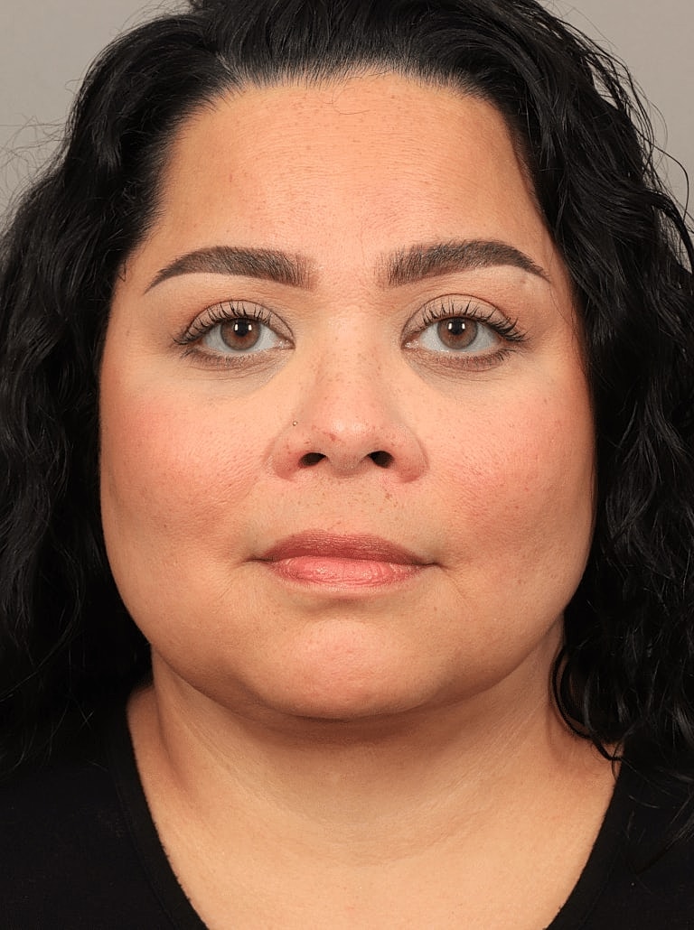 Blepharoplasty Before & After