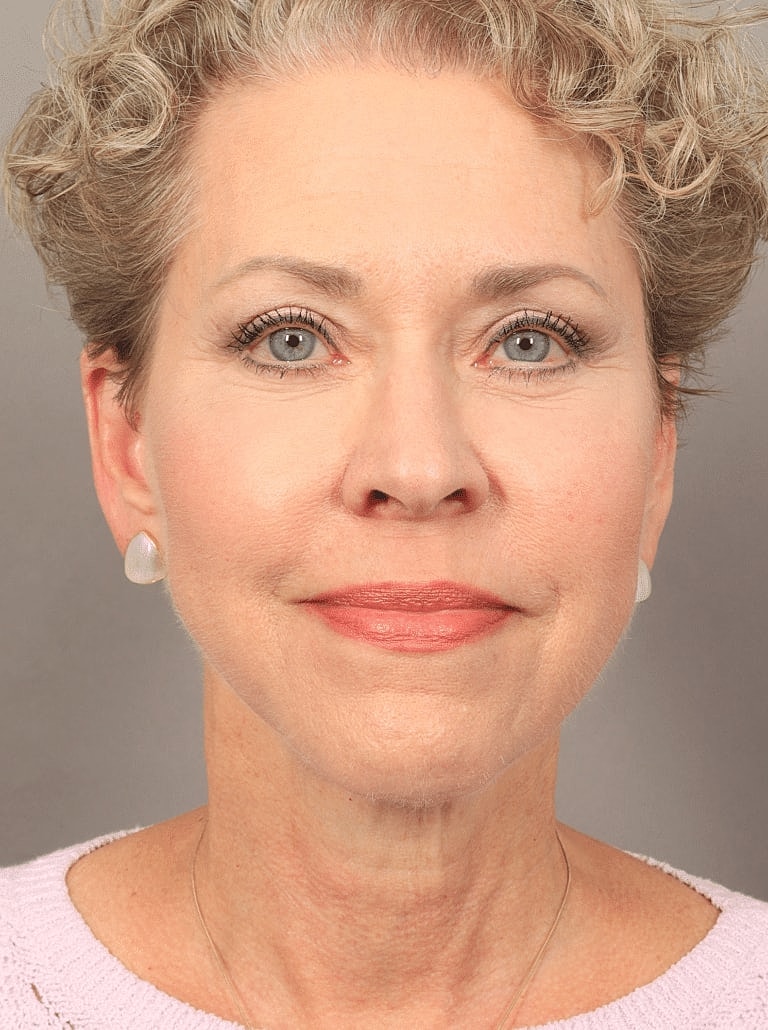 Blepharoplasty Before & After