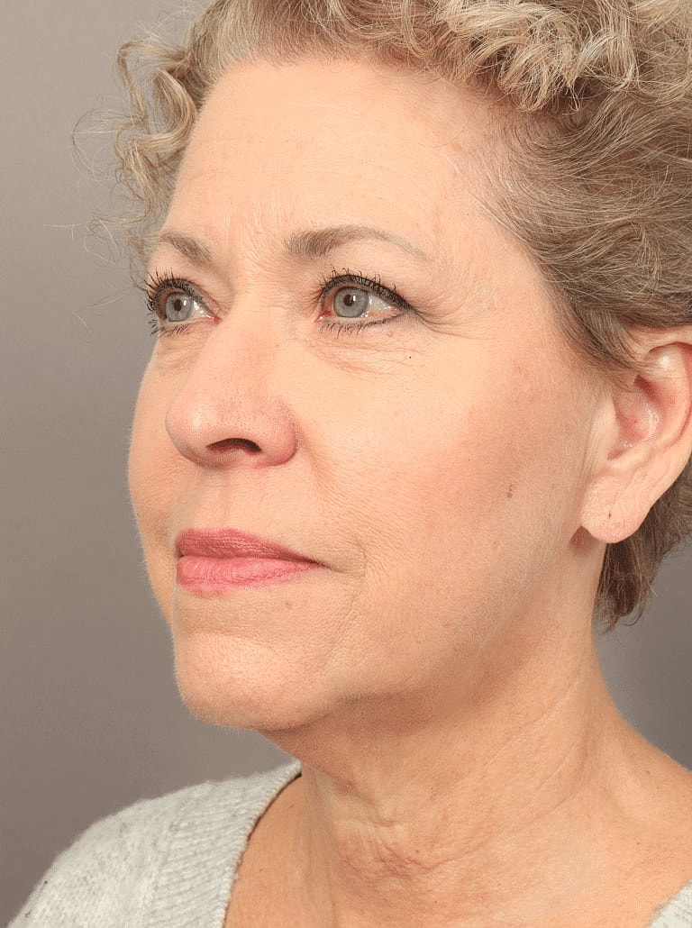 Blepharoplasty Before & After