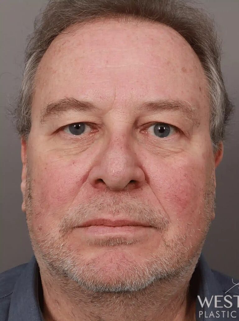 Blepharoplasty Before & After