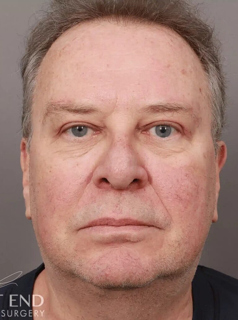 Blepharoplasty Before & After