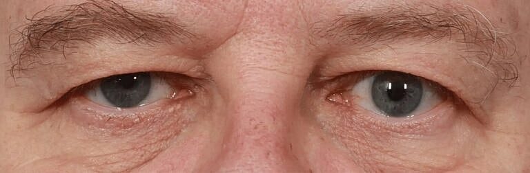 Blepharoplasty Before & After