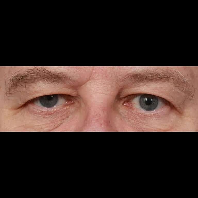 Blepharoplasty Before & After