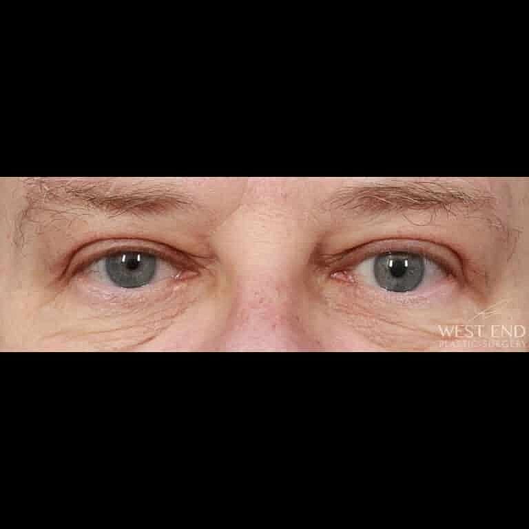 Blepharoplasty Before & After