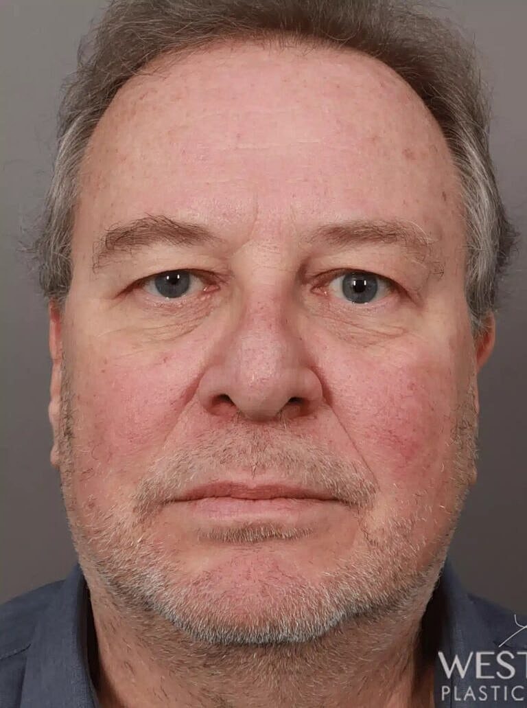 Blepharoplasty Before & After