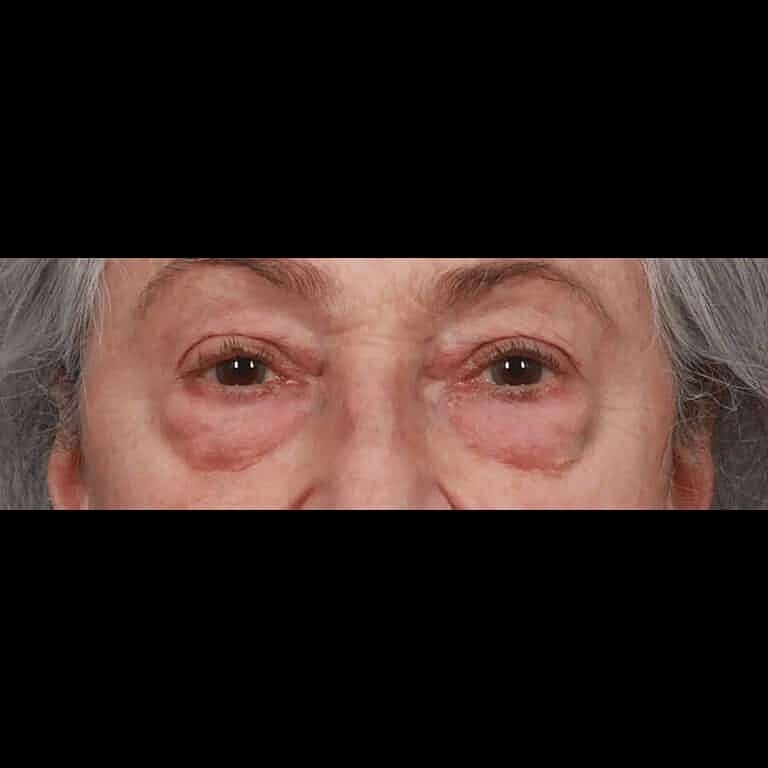 Blepharoplasty Before & After