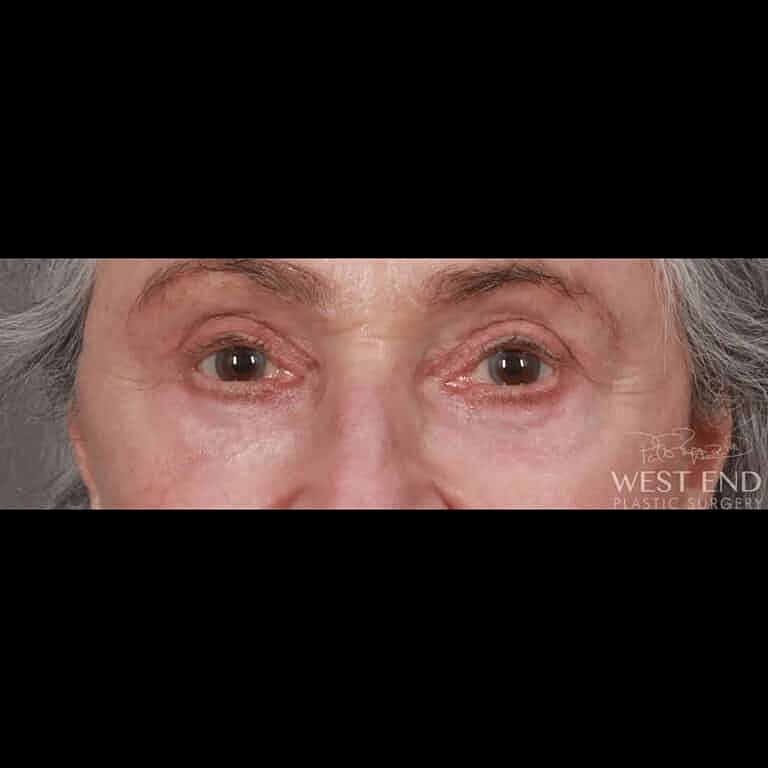 Blepharoplasty Before & After
