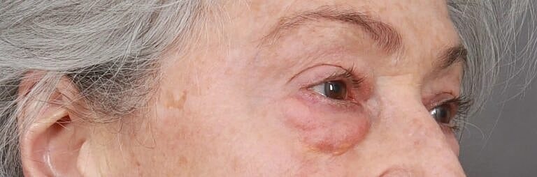 Blepharoplasty Before & After