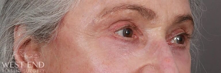 Blepharoplasty Before & After