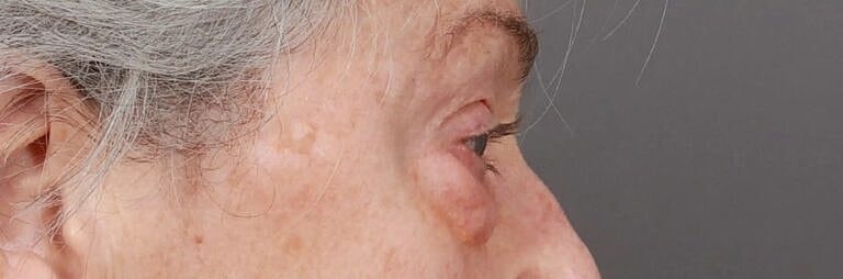 Blepharoplasty Before & After