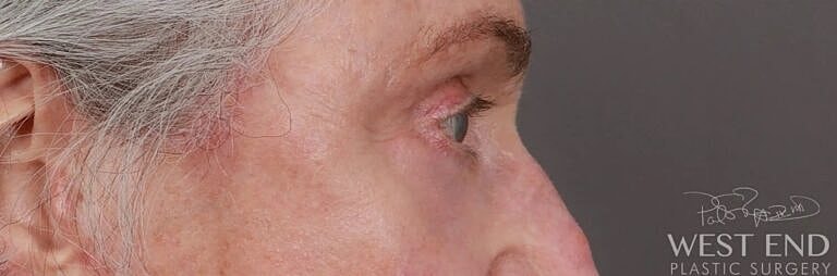 Blepharoplasty Before & After