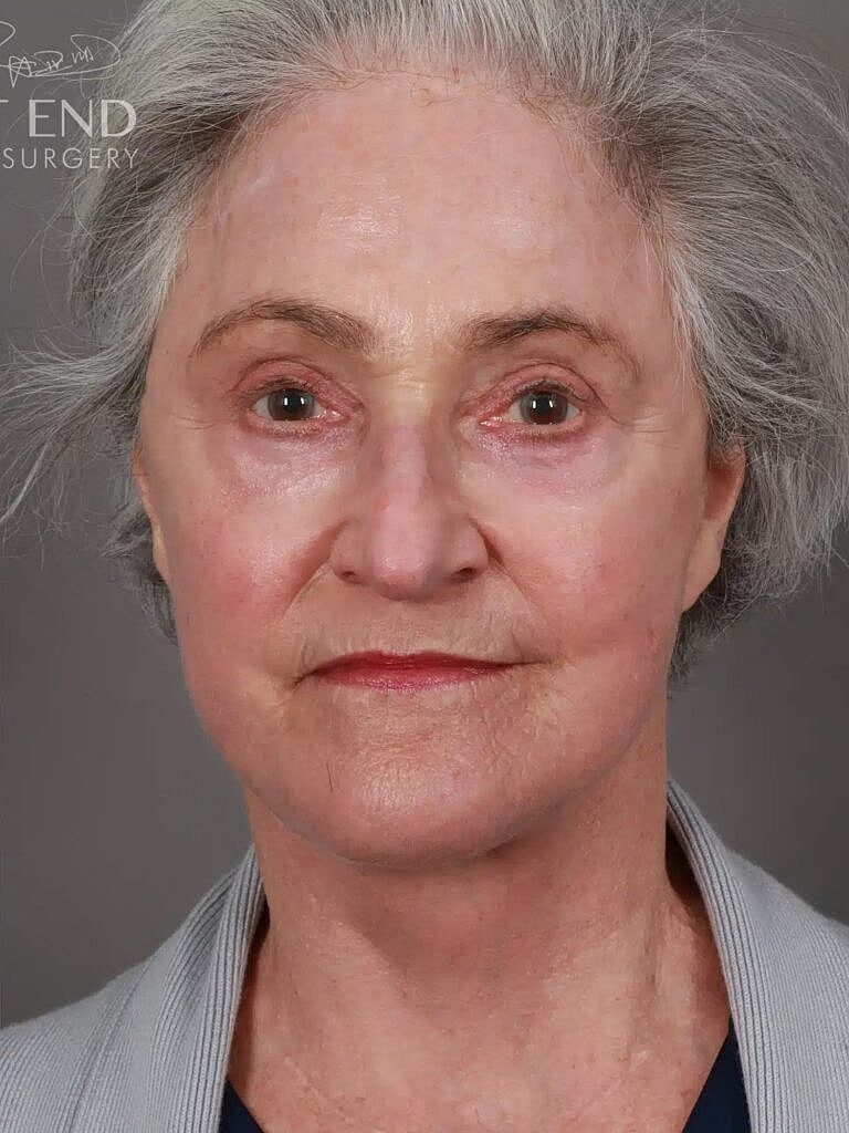 Blepharoplasty Before & After