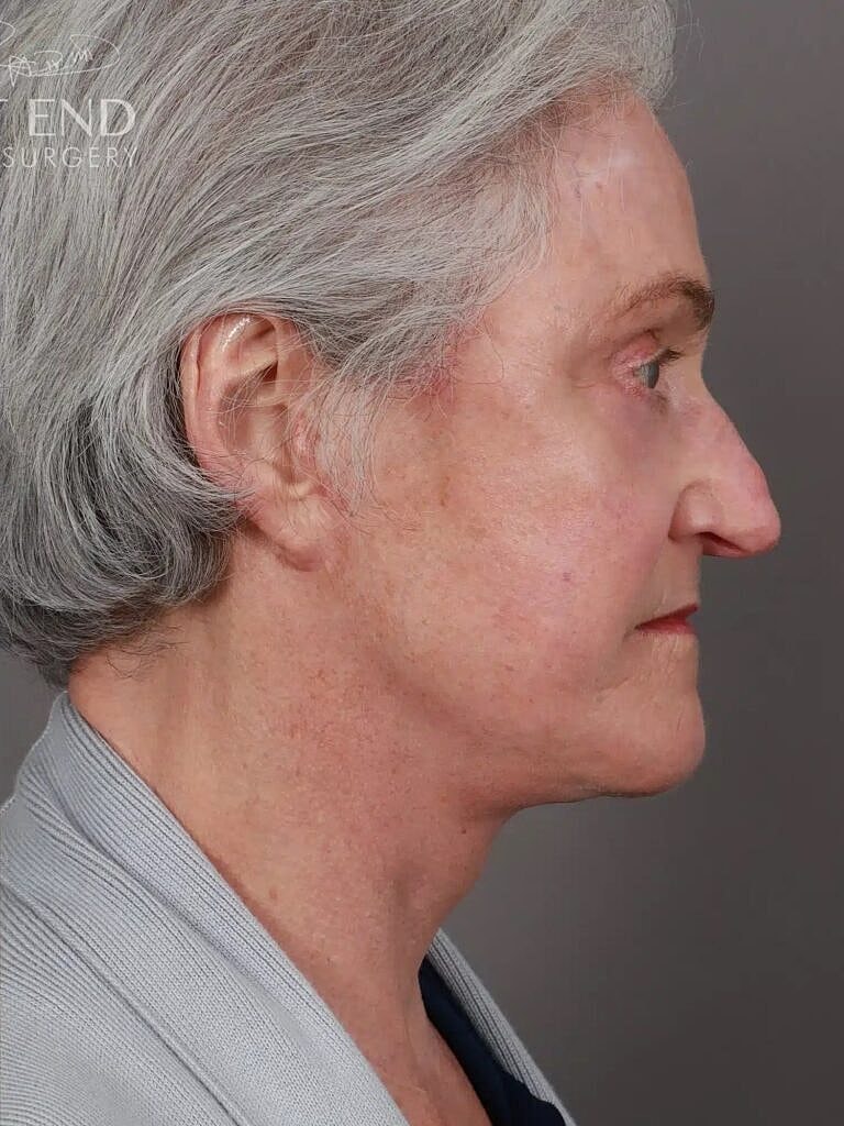 Blepharoplasty Before & After