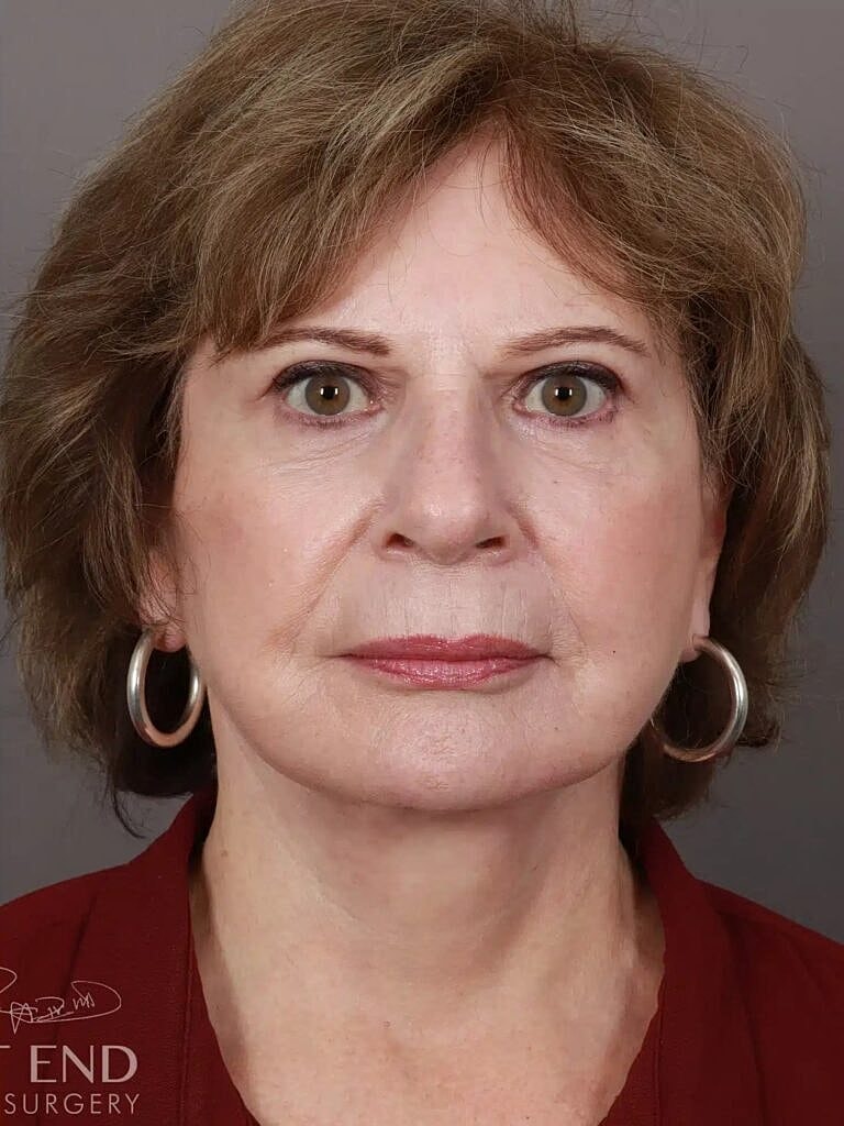 Blepharoplasty Before & After