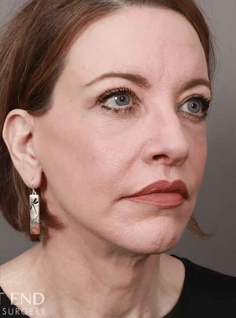 Blepharoplasty Before & After