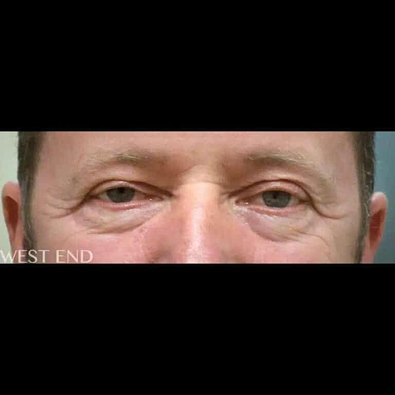 Blepharoplasty Before & After