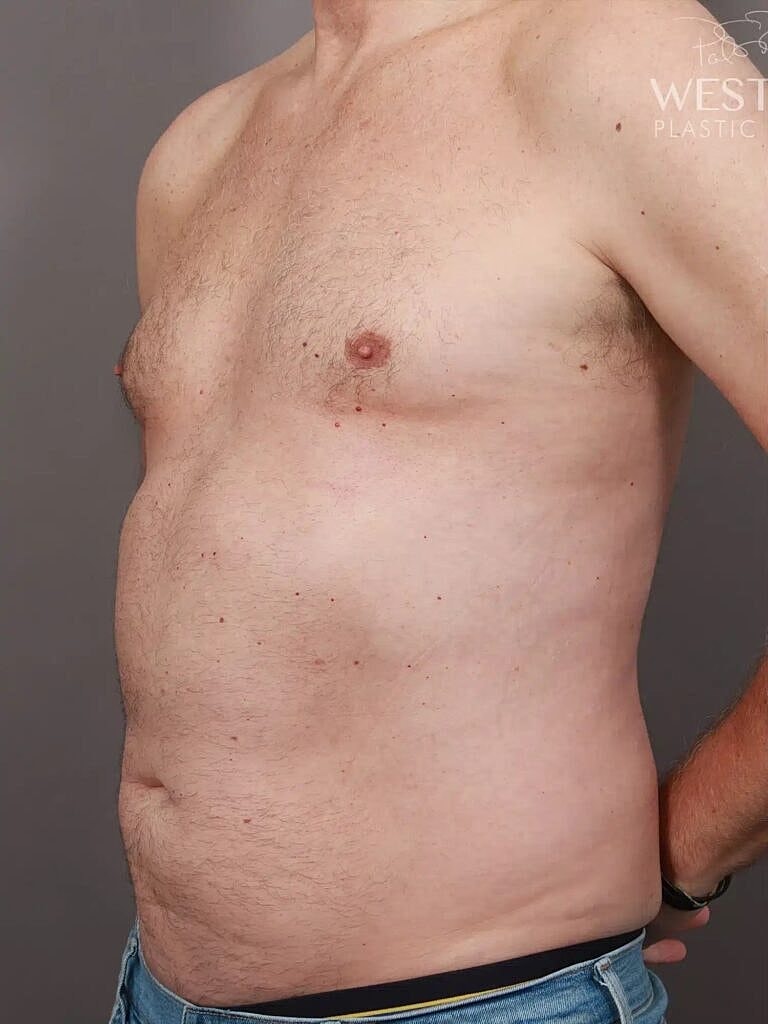 Pectoral Implants Before & After