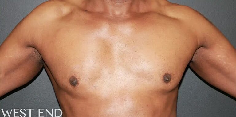 Pectoral Implants Before & After