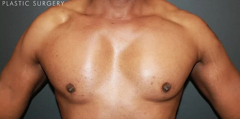 Pectoral Implants Before & After