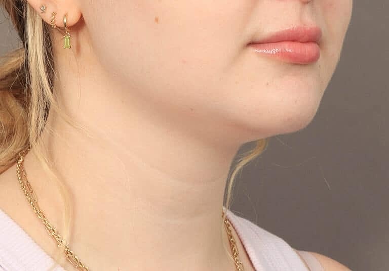 Face Liposuction Before & After