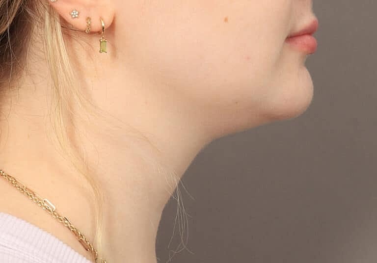 Face Liposuction Before & After