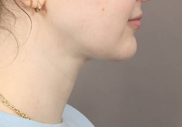 Face Liposuction Before & After