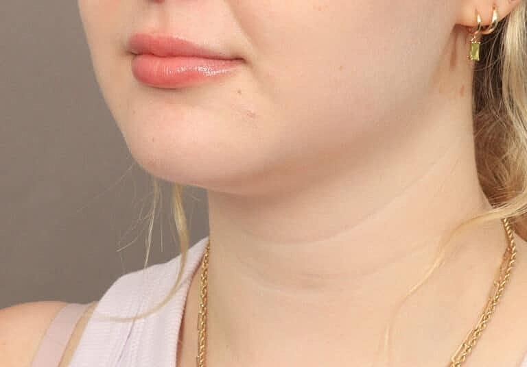 Face Liposuction Before & After