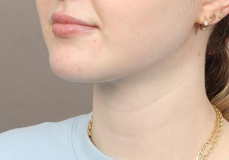 Face Liposuction Before & After