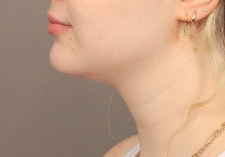 Face Liposuction Before & After