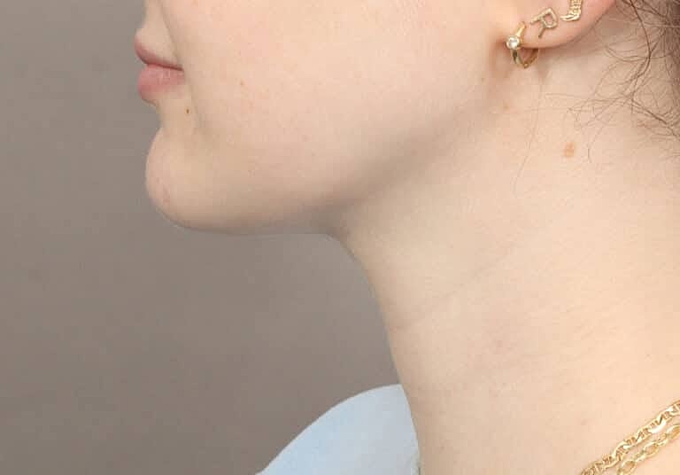 Face Liposuction Before & After