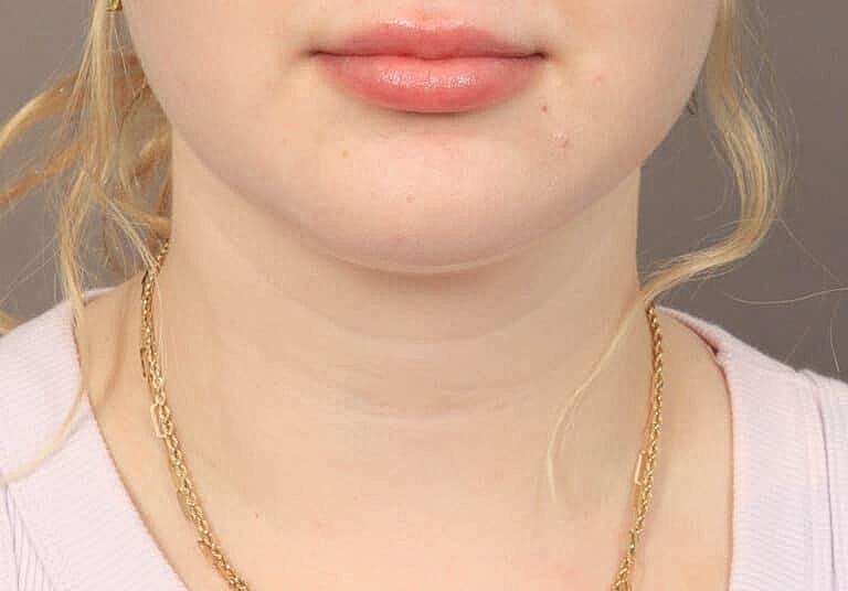 Face Liposuction Before & After