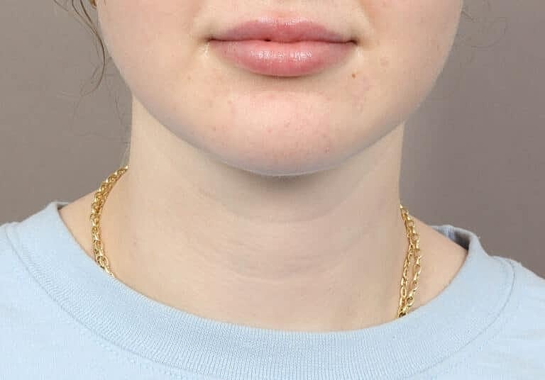 Face Liposuction Before & After