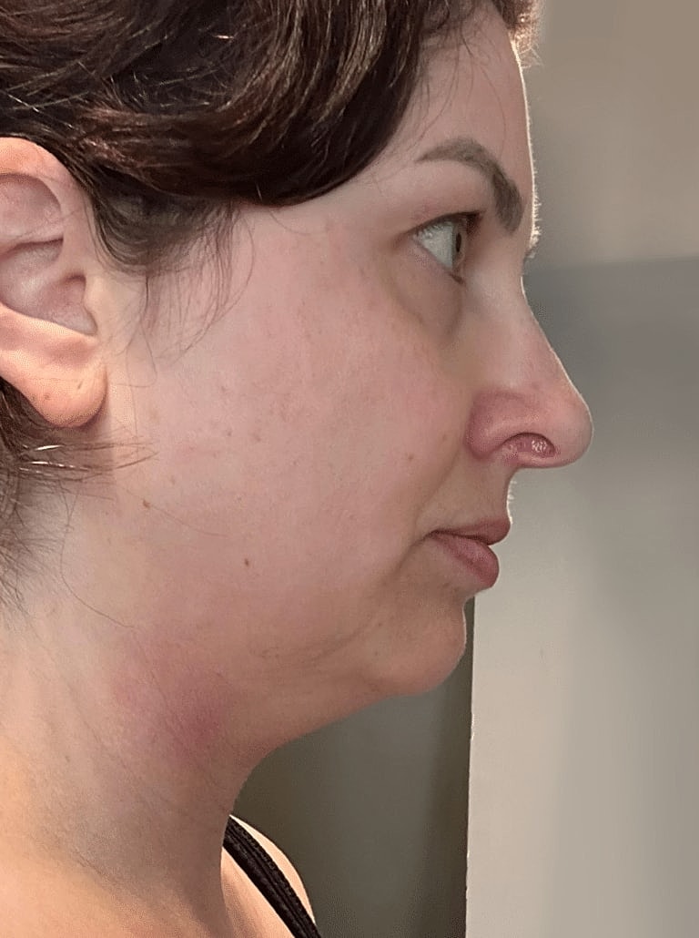 Face Liposuction Before & After