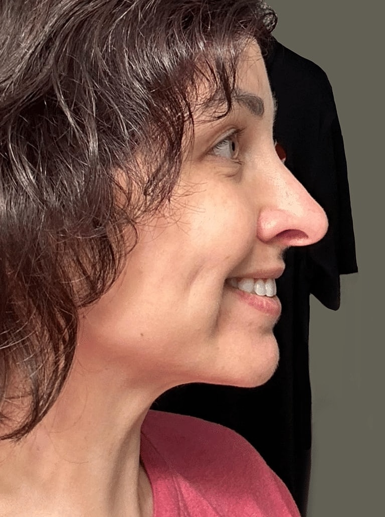 Face Liposuction Before & After