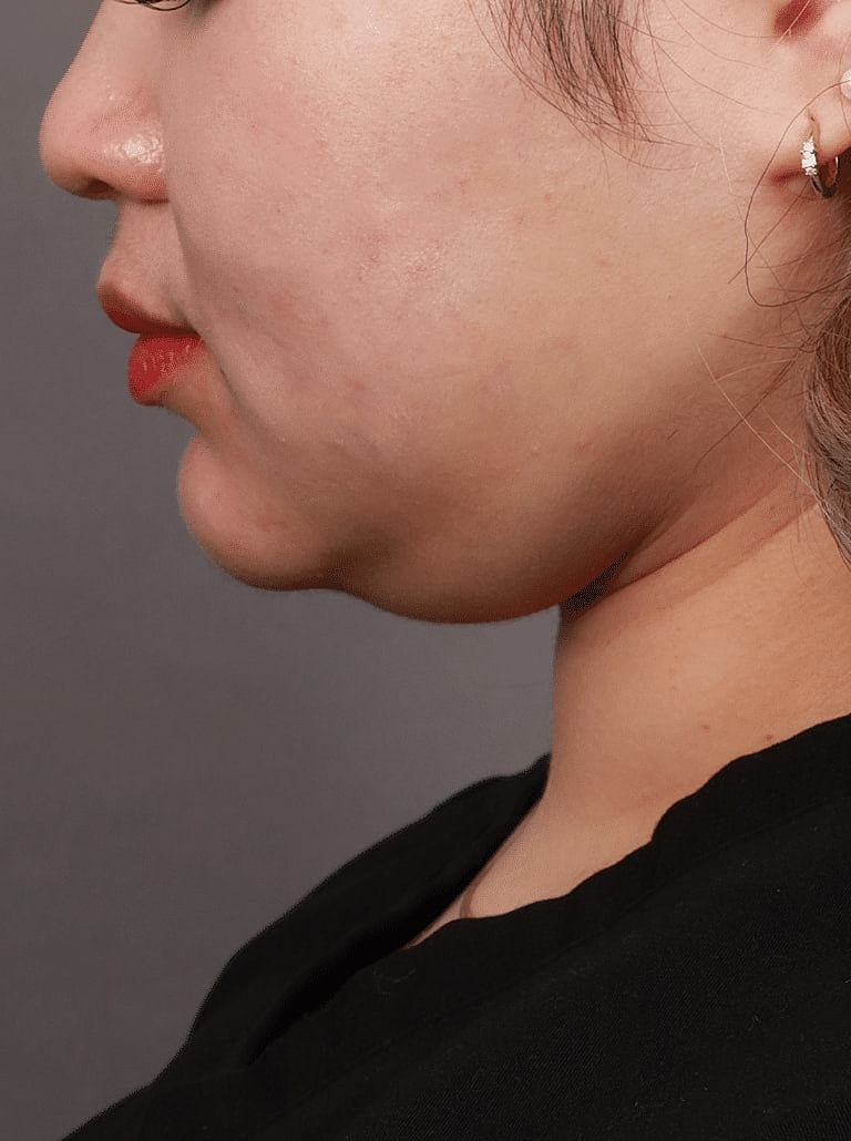 Face Liposuction Before & After