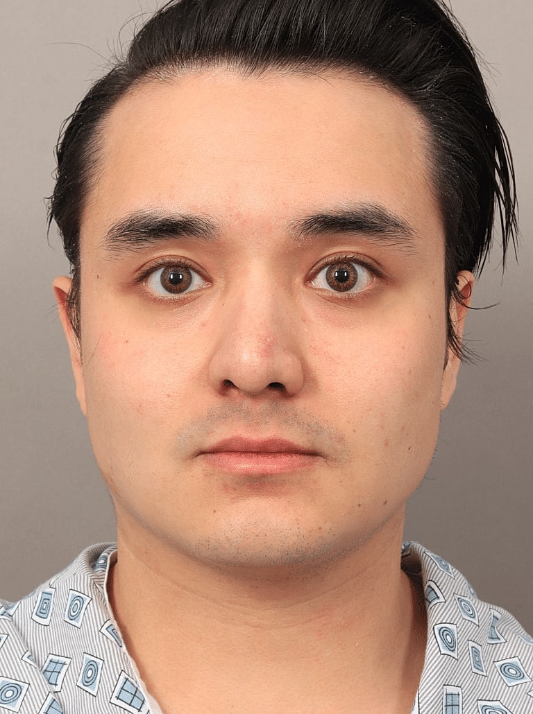 Face Liposuction Before & After