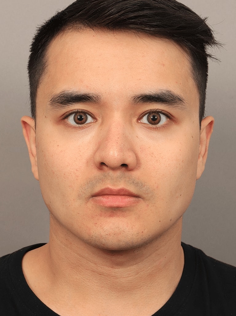 Face Liposuction Before & After