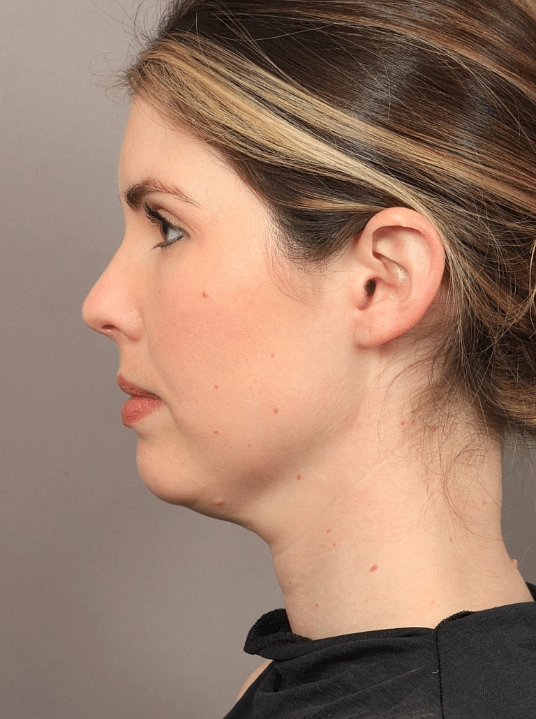 Face Liposuction Before & After